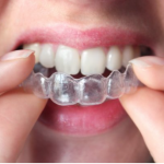 ¿Por qué decidirte por la ortodoncia invisible?
