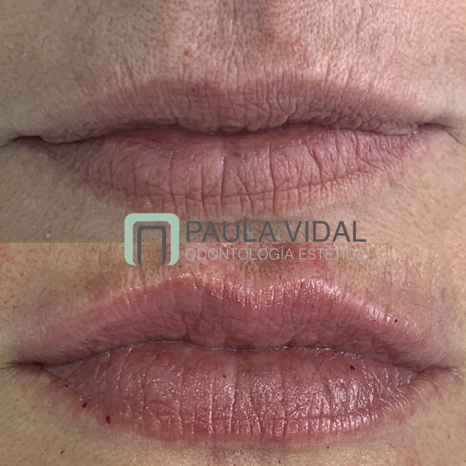 ¿Quieres hidratar, moldear o dar volumen a tus labios?