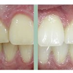 Blanqueamiento dental: mejora en muy poco tiempo tu sonrisa