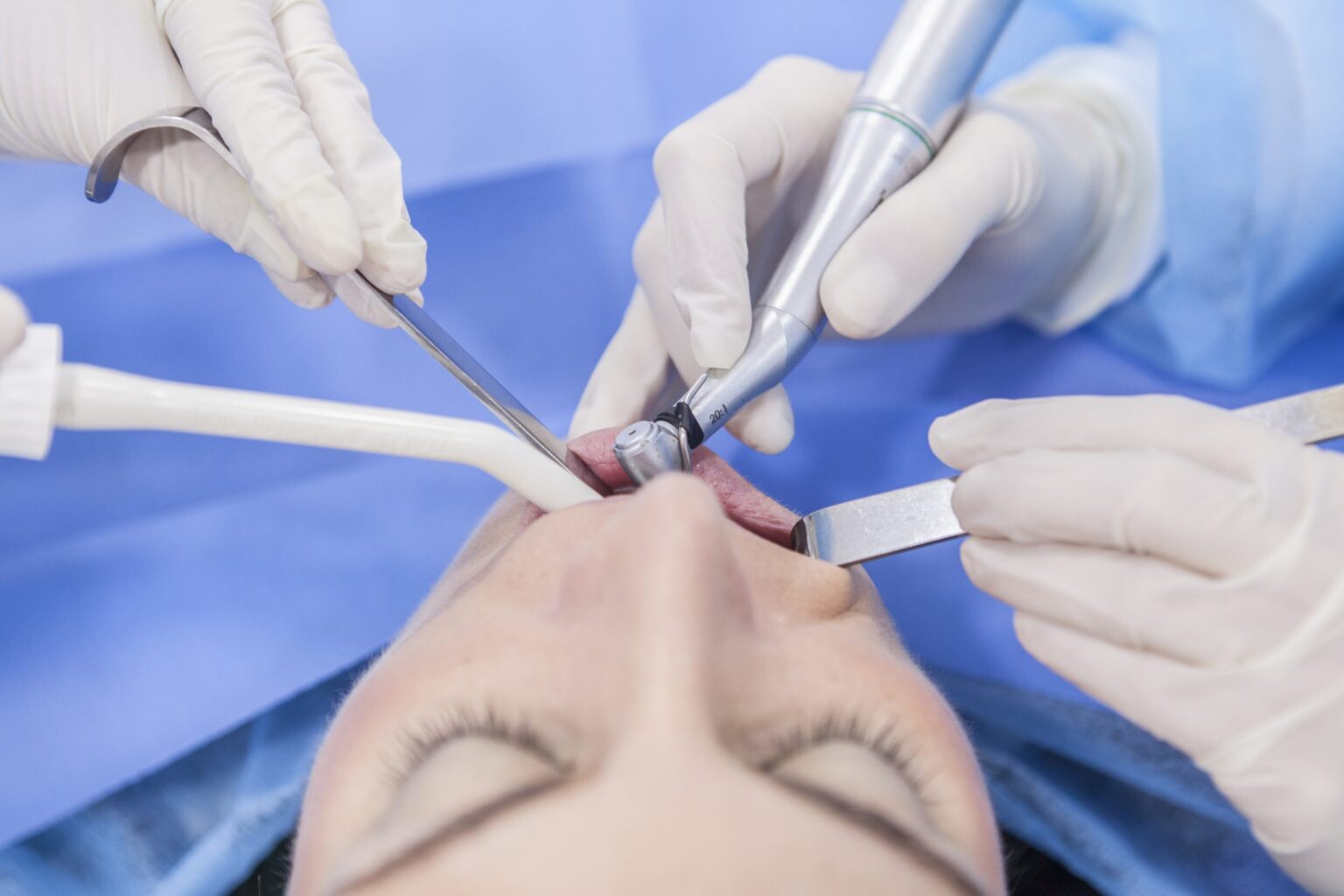 Recupera tu sonrisa completa: Resuelve tus dudas sobre los implantes dentales